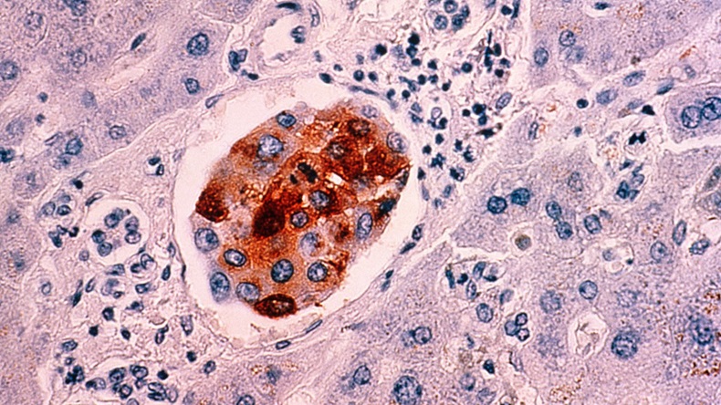 cancer cells (breast)