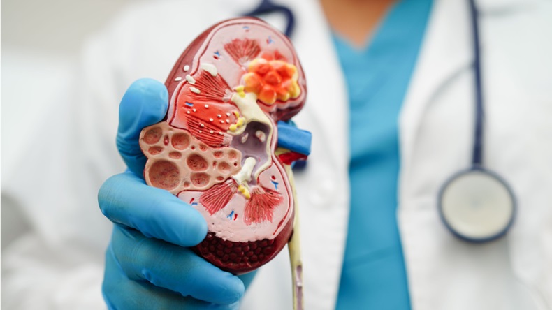 Doctor holding a plastic model of a polycystic kidney